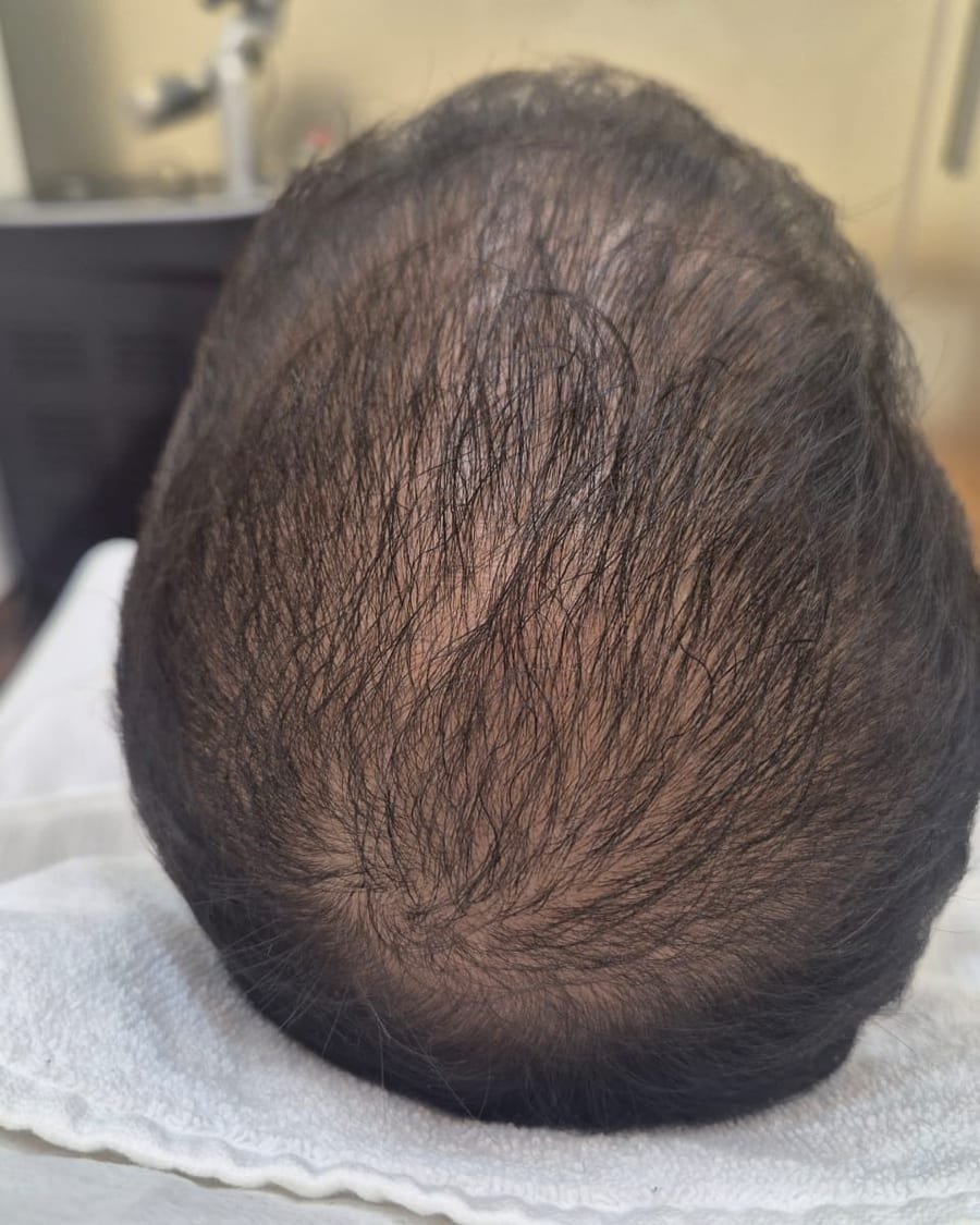 Real clinic patient hair restoration and dense scalp regrowth results after clinical PRP treatment at ABSOLUT AURAA
